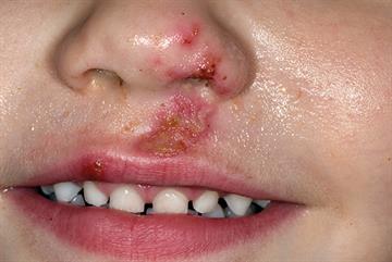 Facial ulcers in children