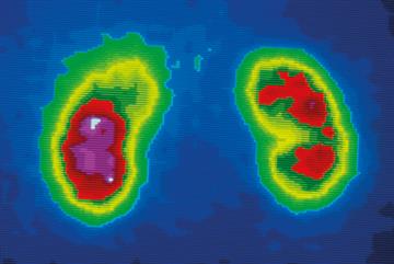 Chronic kidney disease - clinical review