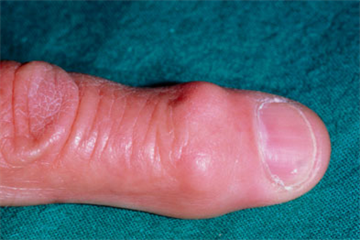 Musculoskeletal - Osteoarthritis of the hand