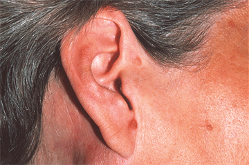 Journals watch: Lymphoma, herd immunity and the safety of older drivers