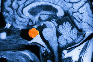 Hyperprolactinaemia: diagnosis and management