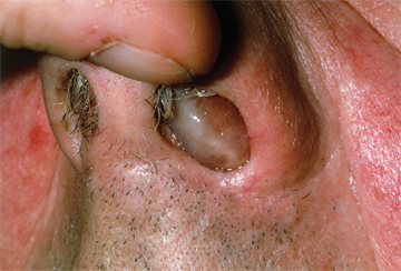 Pictorial case study - Nasal polyps