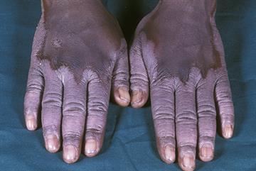 Dermatological conditions in pigmented skin