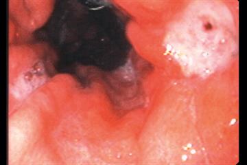 Red flag symptoms - Dyspepsia
