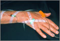 Myasthenia gravis