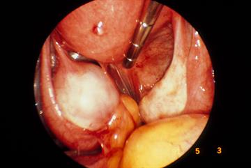 Clinical Review: Endometriosis