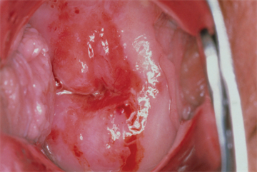 Postcoital bleeding - red flag symptoms