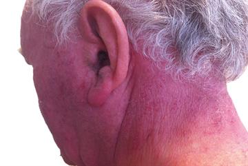 Management of common photodermatoses