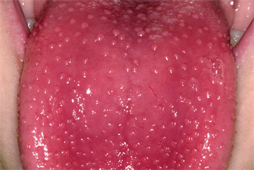 Differential diagnoses - Conditions affecting the tongue