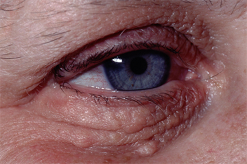 Differential diagnoses: Facial lesions