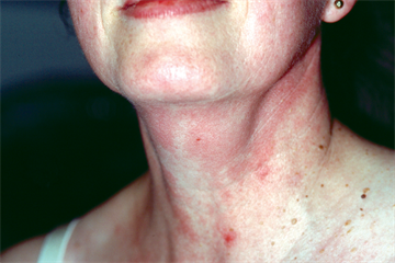 Neck swellings: differential diagnoses