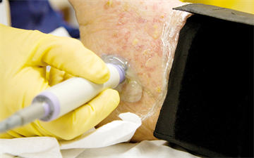 Peripheral arterial disease: identification and management