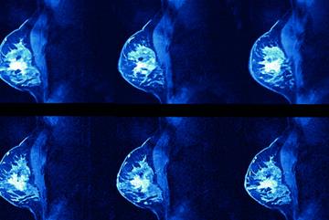 Journals Watch: Vitamin D and cancer risk, glioma and pre-abortion counselling
