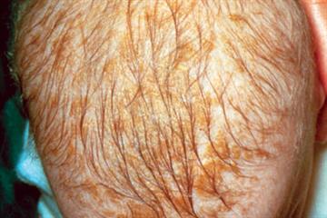 Picture case - Cradle cap
