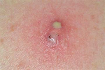 Bacterial infection: illustrated