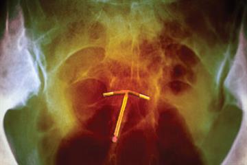Journals watch: IUDs, prostate cancer and alcohol in pregnancy
