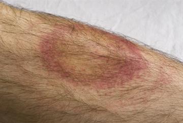 Thousands of patients will contract Lyme disease this year, GPs warned