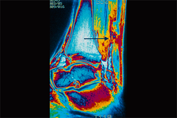 A collaborative approach to Achilles tendon rupture