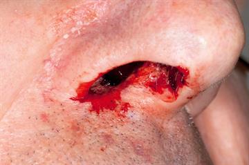 Red flag symptoms: Epistaxis