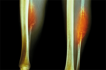 Limb pain in children