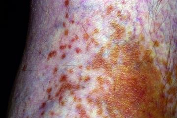 Differential diagnoses: Pigment formation