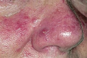 The management of rosacea