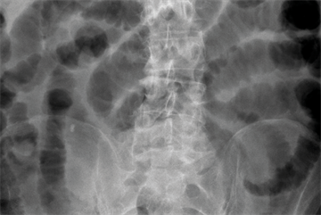 Red flag symptoms: Vomiting in adults