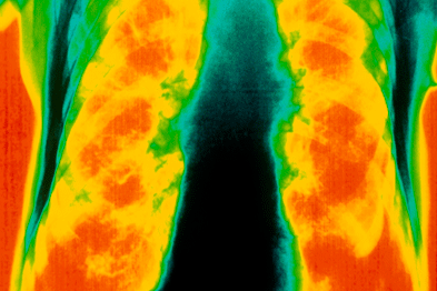 COPD: many prefer pulmonary rehabilitation services closer to home (photograph: SPL)