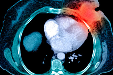 Most breast cancers produce the protein targeted by the vaccine