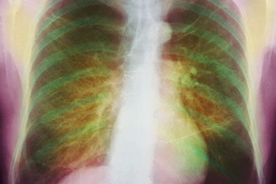 The DoH wants widespread screening for pulmonary emphysema (Photograph: SPL)