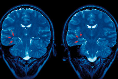 Proposed indicators for epilepsy will not be taken up in 2010/11