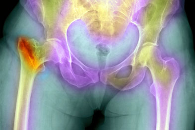 Osteoporotic hip fracture: new tool no substitute for existing FRAX