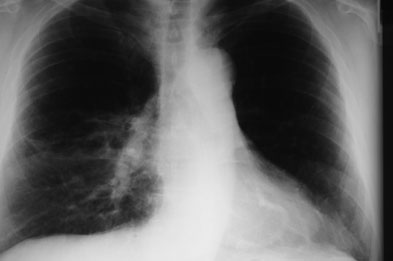 Pneumonia