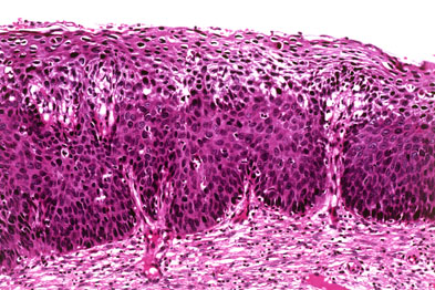 Light micrograph showing grade 2 cervical cancer
