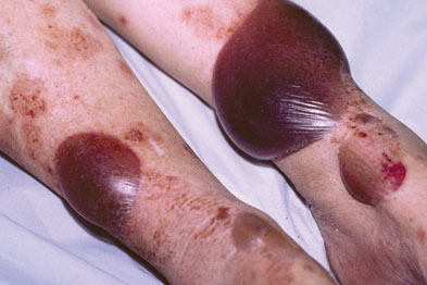 Rash Pictures – Look for Your Rash in these Rash Pictures