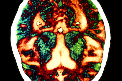 Dementia patients are still being prescribed antipsychotics when other care would be more beneficial