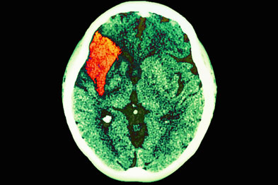 Stroke: cognitive problems can have a significant impact on recovery