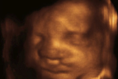 20-year survival rate is 97.6 per cent for fetal orofacial anomalies