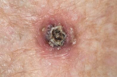 Dome-shaped nodule with central crater and keratin plug (Photograph: Dr P Marazzi/SPL)