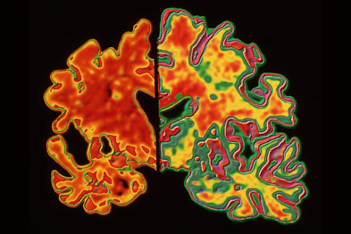 Alzheimer's: genetic link shown