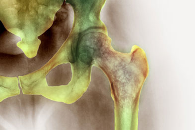 Hip osteoporosis: inhibiting serotonin levels is a new treatment target