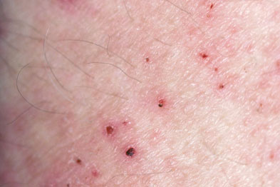 Scabies: Treatment and Scabies Rash Facts - MedicineNet