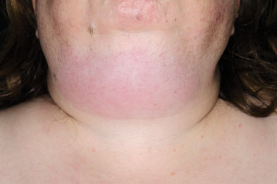 Pictorial case study - Submandibular swelling | GPonline