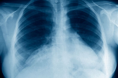 Pneumonia: atypical antipsychotic drugs raised risk 2.6 times