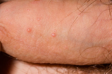 Molluscum Contagiosum On The Penis 100