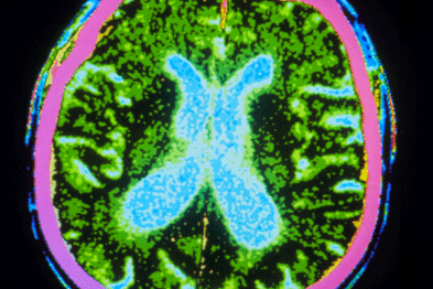 Link between vitamin D and Parkinson's (above) needs more research (Photograph: SPL)