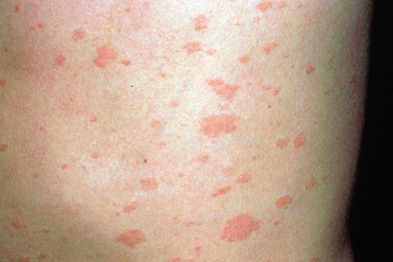 Pictorial Case Study: Itchy Rash With A Large Lesion 