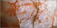 HPV types 6 and 11 cause nine out of 10 cases of genital warts