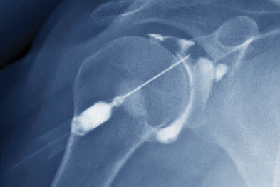 Steroid injections shoulder bursitis