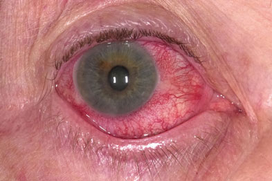 Steroid eye drops viral infection